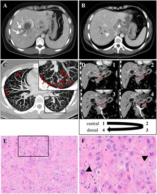 Fatal Myelotoxicity Following Palliative Chemotherapy With Cisplatin and Gemcitabine in a Patient With Stage IV Cholangiocarcinoma Linked to Post Mortem Diagnosis of Fanconi Anemia